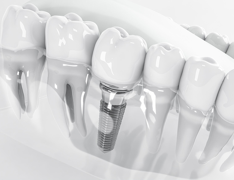 川越駅西口すぐの歯医者、グリーン歯科・矯正歯科のインプラント治療